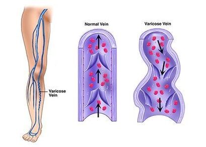 Neoveris verhindert die Entwicklung von venösen Pathologien