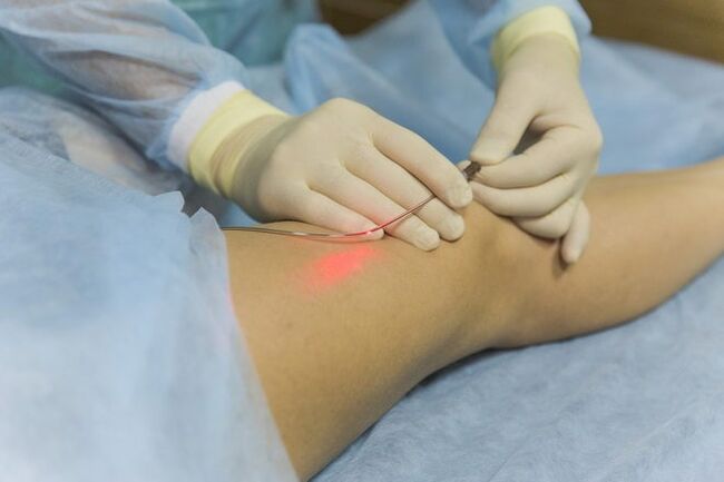 Laserbehandlung von Krampfadern.