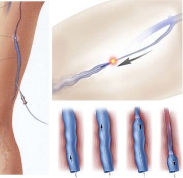 Behandlungsmethode für Krampfadern endovenöse Laserkoagulation