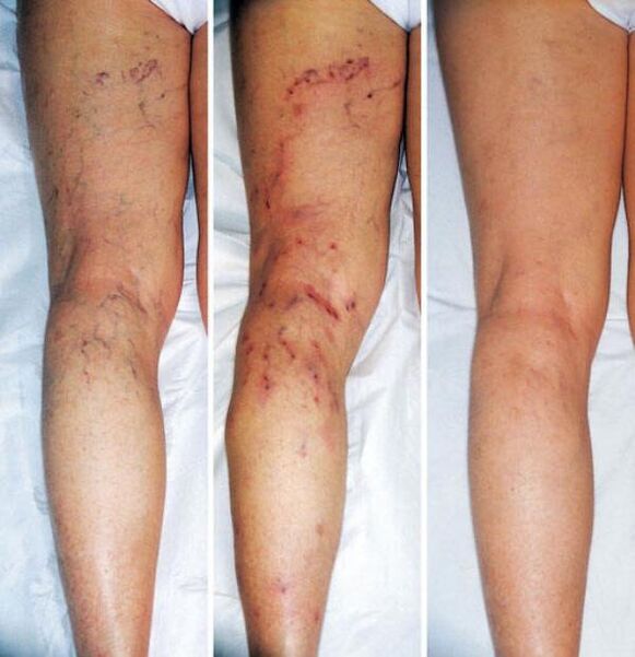 Stadien von Krampfadern der unteren Extremitäten.