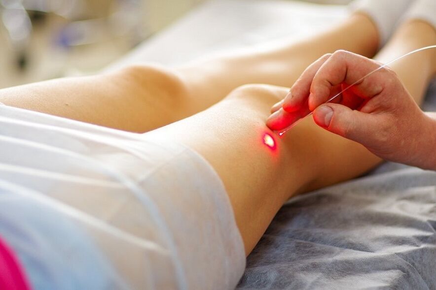 Laserbehandlung von Krampfadern