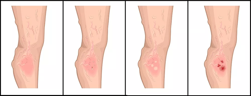 Stadien der Entwicklung trophischer Geschwüre in der Venenpathologie. 