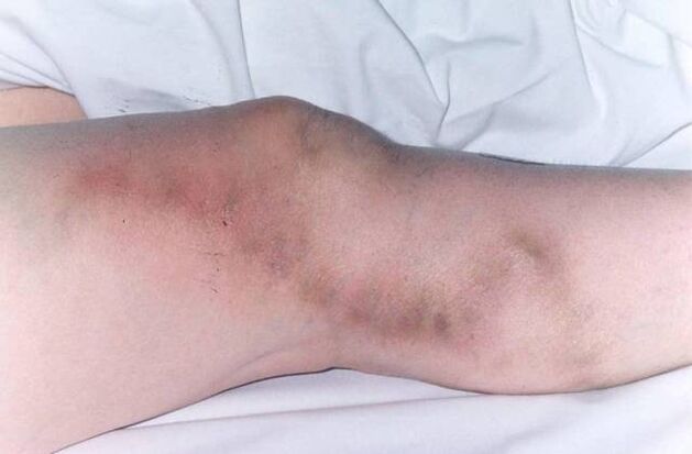 Thrombophlebitis mit fortgeschrittenen Krampfadern